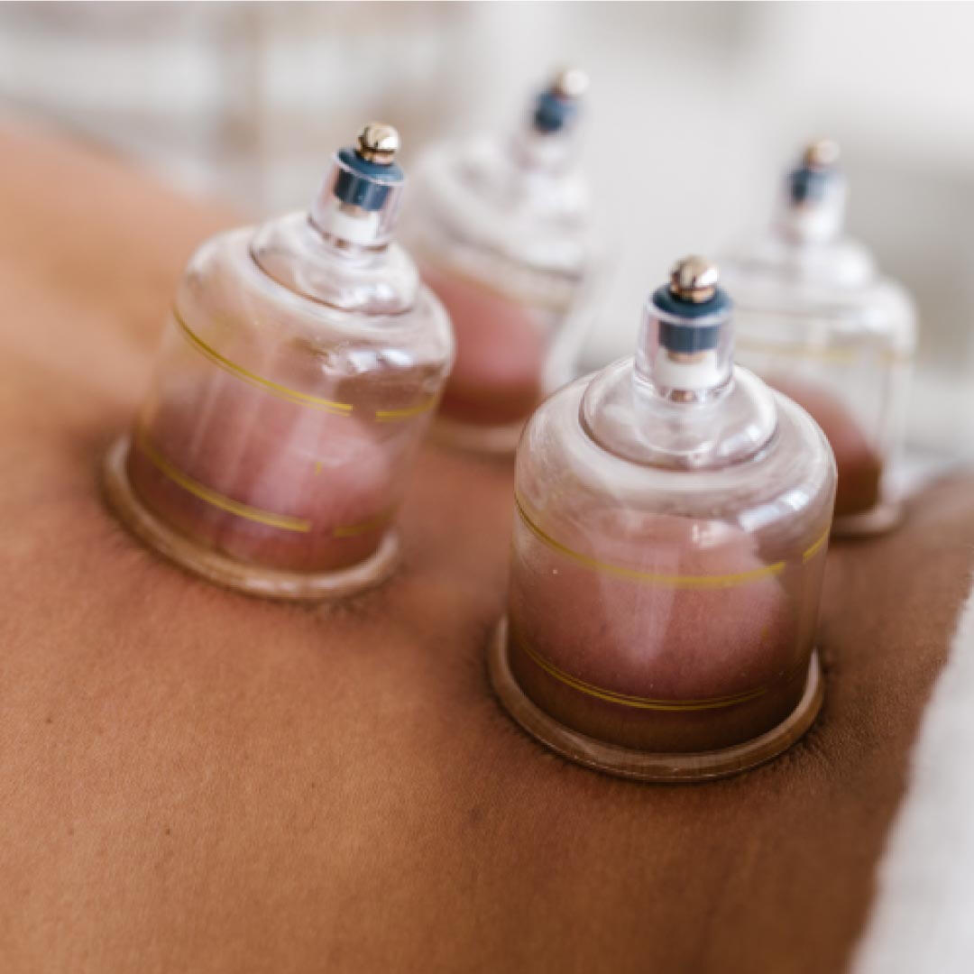 Assoform ISM APS Corso di Coppettazione & Moxibustione